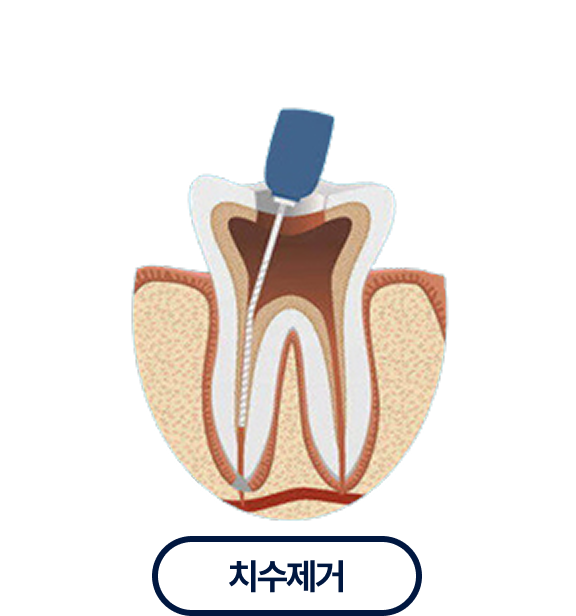 치수제거